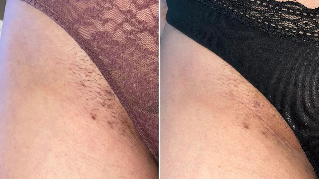 Severe skin discoloration