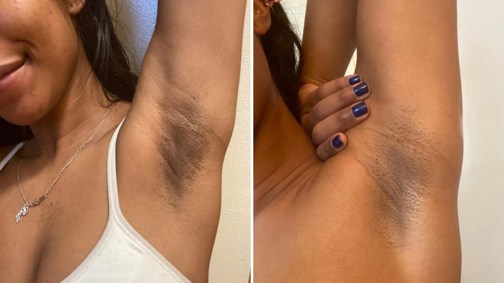Dark underarms