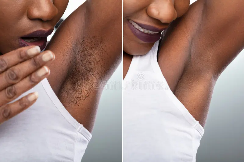 Underarm skin irritation