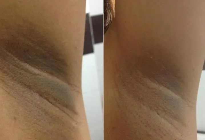 Dark inner thighs